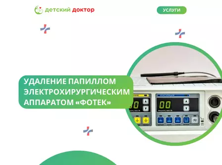 Удаление папиллом электрохирургическим аппаратом «Фотек»